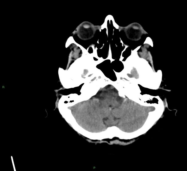File:Cerebral amyloid angiopathy-associated lobar intracerebral hemorrhage (Radiopaedia 58561-65724 Axial non-contrast 38).jpg