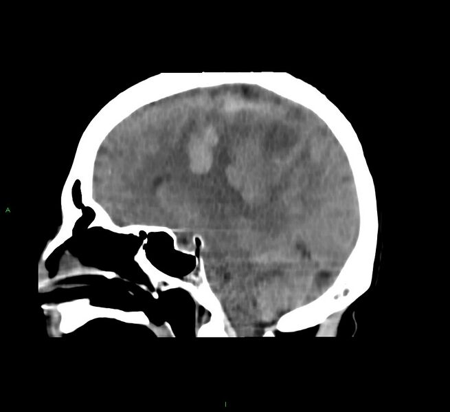 File:Cerebral amyloid angiopathy-associated lobar intracerebral hemorrhage (Radiopaedia 58751-65972 C 28).jpg