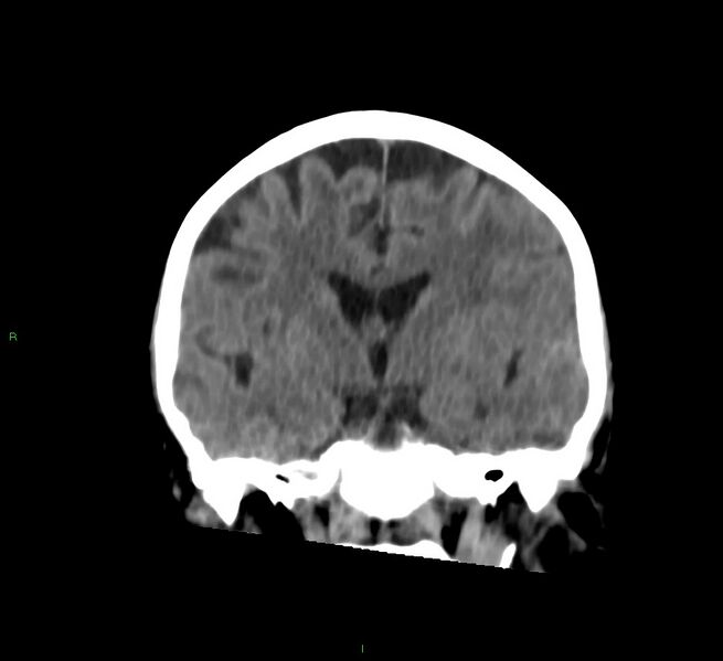 File:Cerebral amyloid angiopathy-associated lobar intracerebral hemorrhage (Radiopaedia 58757-65978 Coronal non-contrast 38).jpg