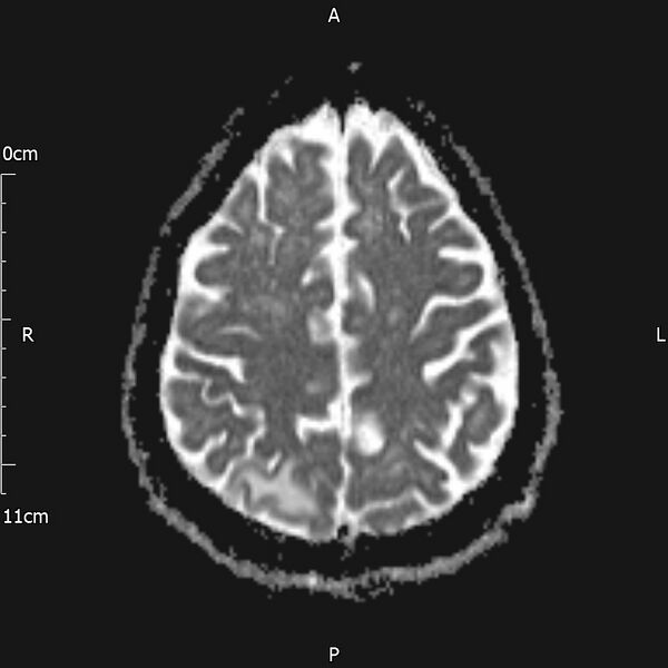 File:Cerebral amyloid angiopathy related inflammation (Radiopaedia 72772-83415 Axial ADC 18).jpg
