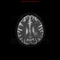 Cerebral and orbital tuberculomas (Radiopaedia 13308-13311 Axial T2 15).jpg
