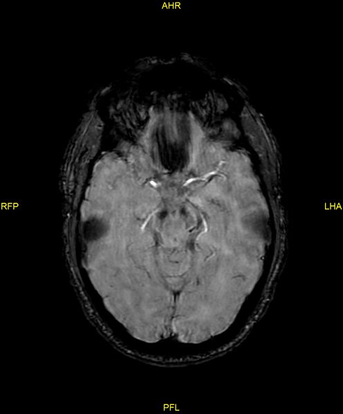 File:Cerebral autosomal dominant arteriopathy with subcortical infarcts and leukoencephalopathy (CADASIL) (Radiopaedia 86108-102054 Axial SWI 45).jpg
