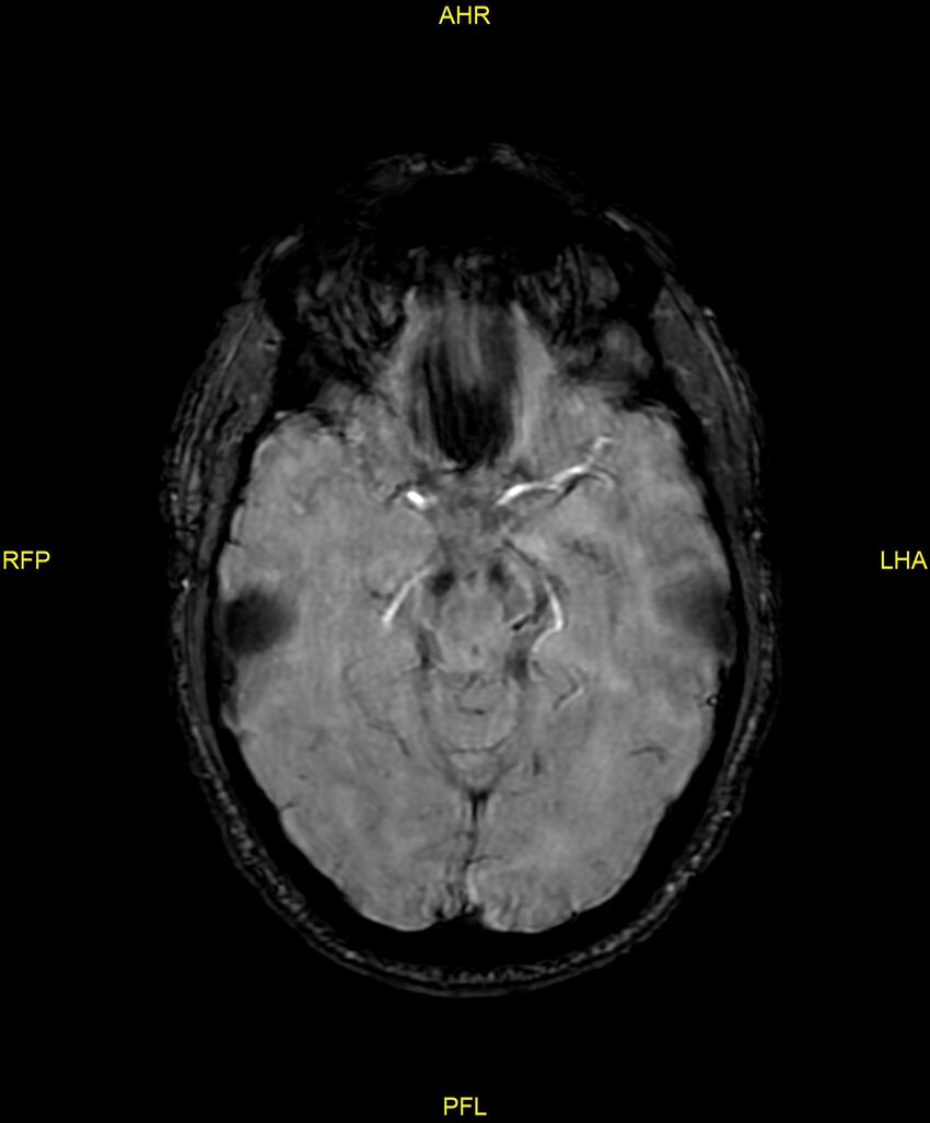 Cerebral autosomal dominant arteriopathy with subcortical infarcts and leukoencephalopathy (CADASIL) (Radiopaedia 86108-102054 Axial SWI 45).jpg