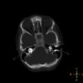 Cerebral contusion (Radiopaedia 48869-53911 Axial bone window 18).jpg