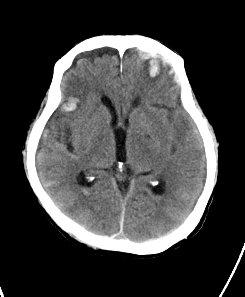 File:Cerebral contusions, subarachnoid hemorrhage and subdural hygromas (Radiopaedia 55399-61828 Axial non-contrast 14).png