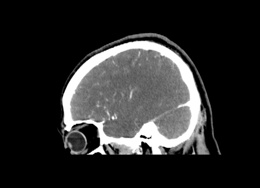 Cerebral edema (Radiopaedia 82519-96661 D 16).jpg