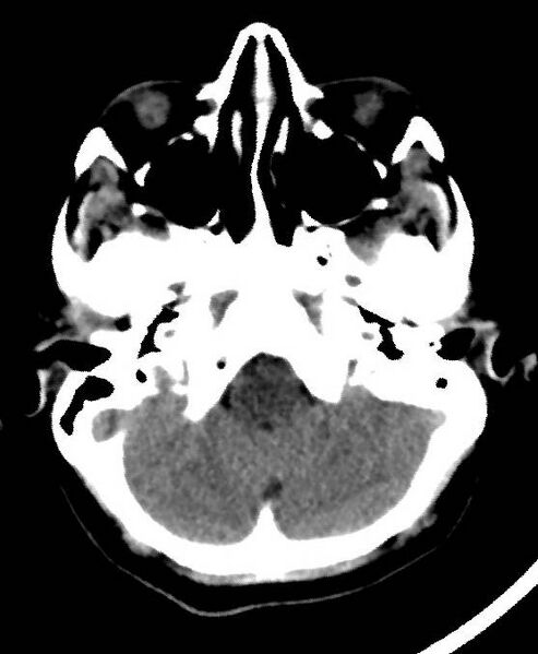File:Cerebral edema due to severe hyponatremia (Radiopaedia 89826-106937 Axial non-contrast 15).jpg