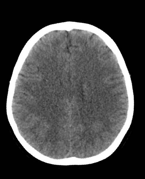 File:Cerebral edema due to severe hyponatremia (Radiopaedia 89826-106938 Axial non-contrast 67).jpg