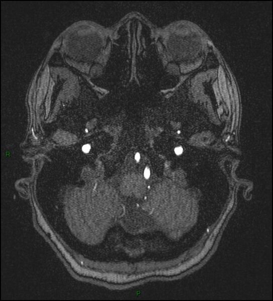 File:Cerebral fat embolism (Radiopaedia 35022-36525 Axial TOF 27).jpg