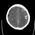 Cerebral hemorrhagic contusions (Radiopaedia 23145-23188 Axial non-contrast 29).jpg