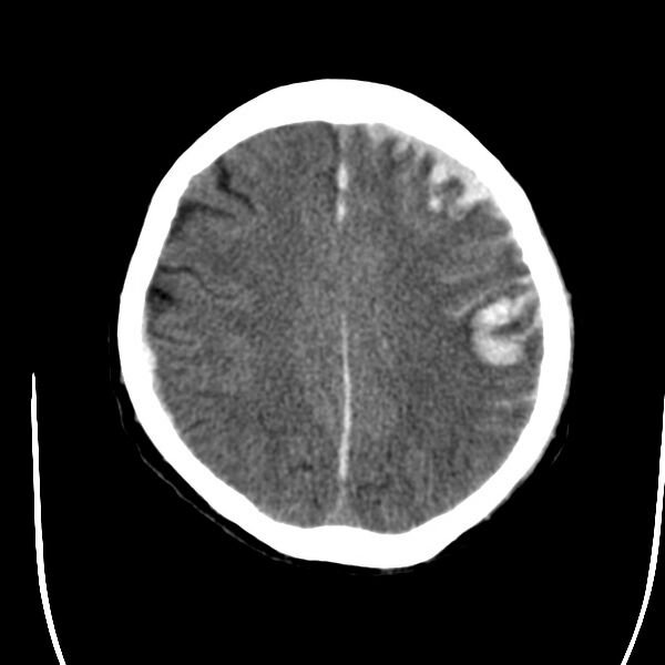 File:Cerebral hemorrhagic contusions (Radiopaedia 23145-23188 Axial non-contrast 29).jpg