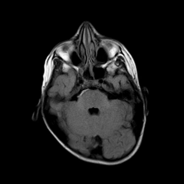 File:Cerebral tuberculoma (Radiopaedia 41152-43932 Axial FLAIR 6).jpg