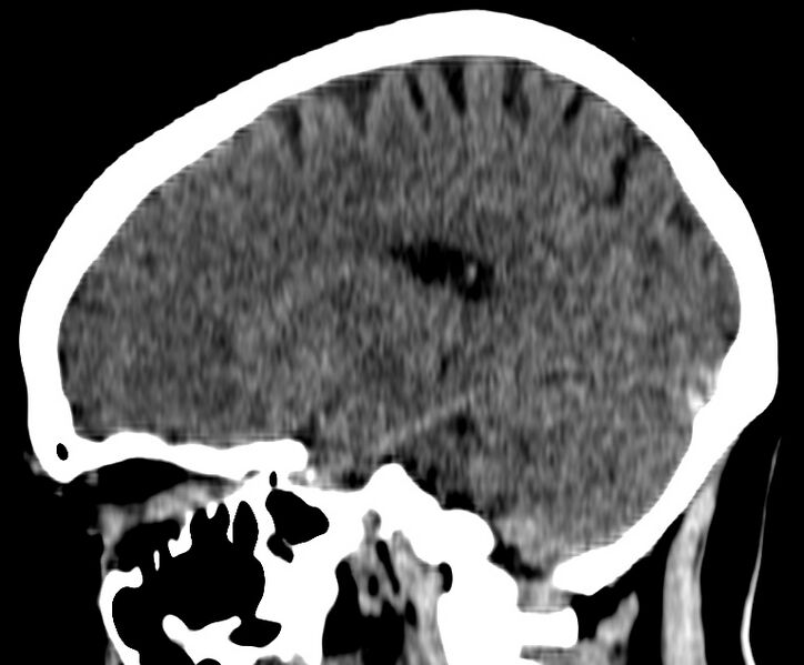 File:Cerebral venous thrombosis - CT only (Radiopaedia 41031-43778 B 24).jpg
