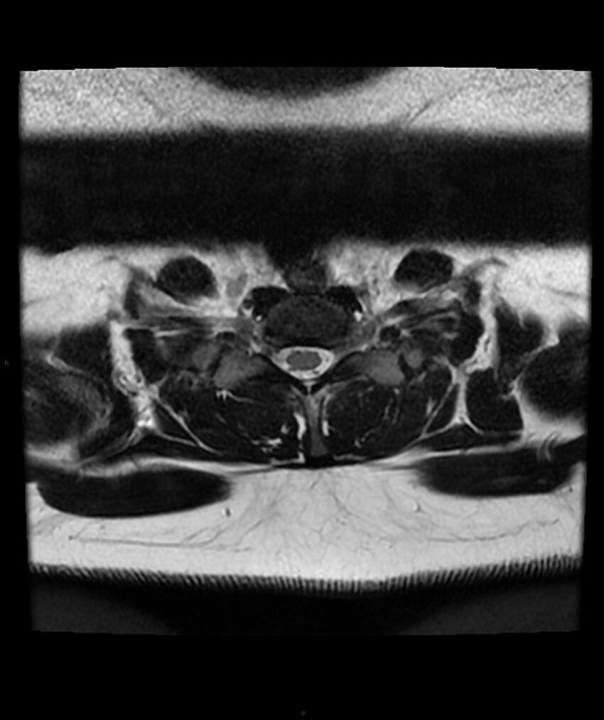 Cervical disc prolapse (Radiopaedia 80258-93598 Axial T2 74).jpg