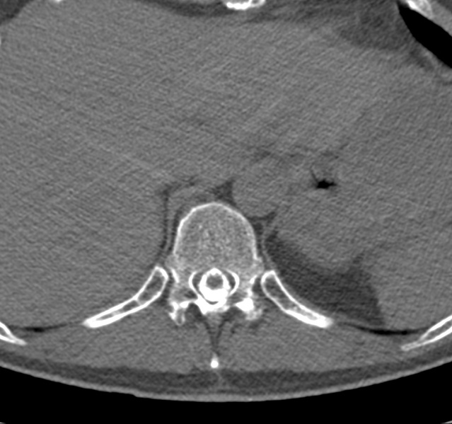 File:Cervical dural CSF leak on MRI and CT treated by blood patch (Radiopaedia 49748-54996 B 78).png