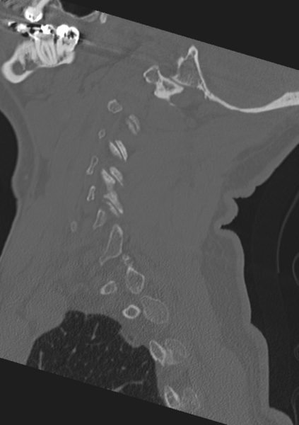 File:Cervical spine fractures with vertebral artery dissection (Radiopaedia 53296-59268 Sagittal bone window 53).png