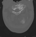 Cervical spondylolysis (Radiopaedia 49616-54811 Axial bone window 15).png