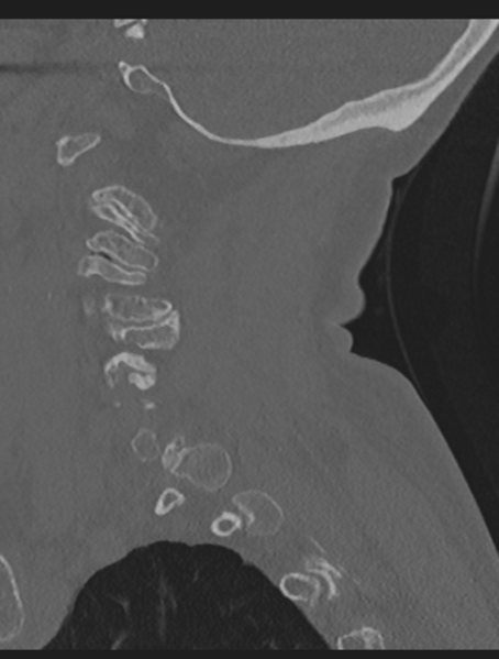 File:Cervical spondylolysis (Radiopaedia 49616-54811 Sagittal bone window 18).png