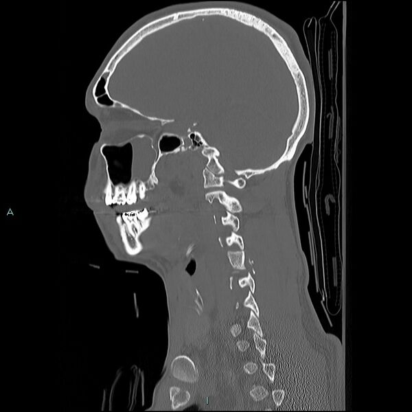 File:Cervical vertebral burst fracture (Radiopaedia 37420-39258 Sagittal bone window 7).jpg