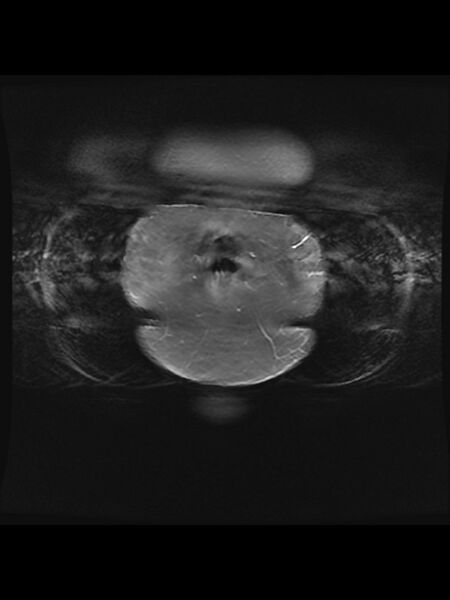 File:Cesarean section scar endometrioma (Radiopaedia 56569-63297 Coronal STIR 2).jpg
