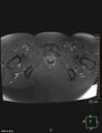 Cesarian scar endometriosis (Radiopaedia 68495-78066 Axial T1 C+ fat sat 24).jpg