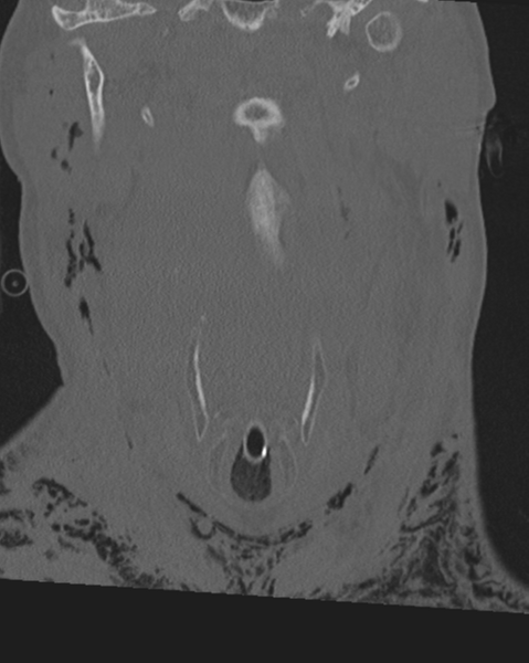 File:Chalk stick fracture (Radiopaedia 57948-64928 Coronal bone window 17).png