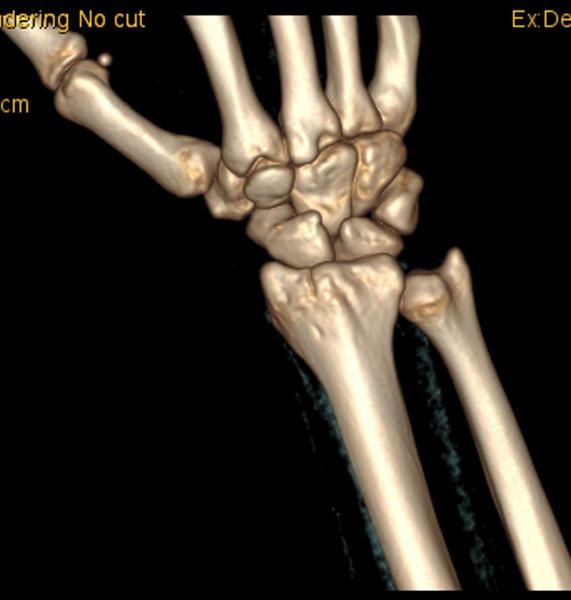 File:Chauffeur's (Hutchinson) fracture (Radiopaedia 58043-65079 3D volume rendered images 2).png