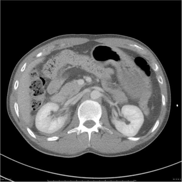 File:Chest and abdomen multi-trauma (Radiopaedia 26294-26426 bone window 32).jpg