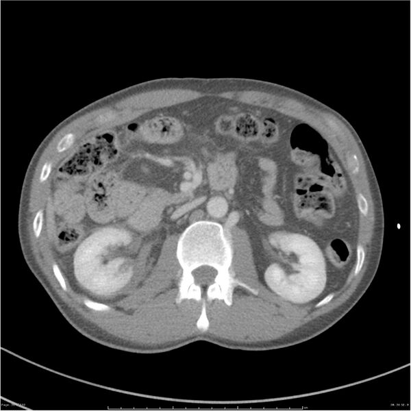 File:Chest and abdomen multi-trauma (Radiopaedia 26294-26426 bone window 36).jpg
