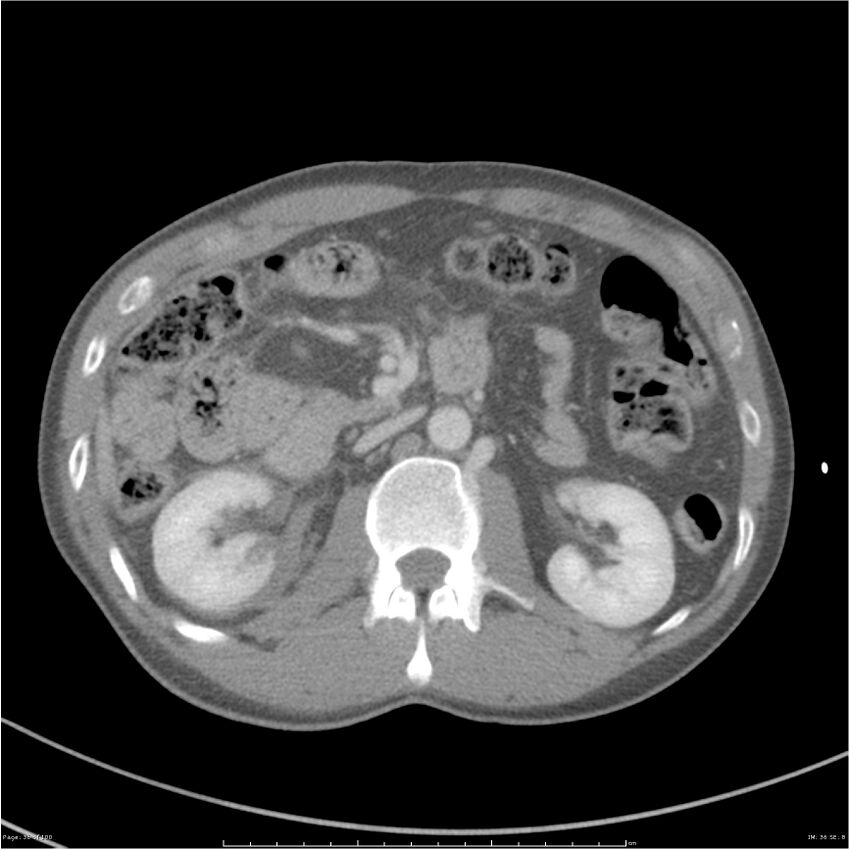 Chest and abdomen multi-trauma (Radiopaedia 26294-26426 bone window 36).jpg