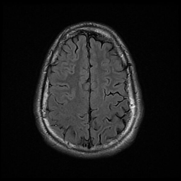 File:Chiasmatic-hypothalamic juvenile pilocytic astrocytoma (Radiopaedia 78533-91235 Axial FLAIR 22).jpg