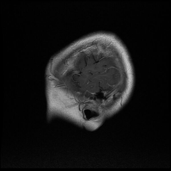 File:Chiasmatic-hypothalamic juvenile pilocytic astrocytoma (Radiopaedia 78533-91236 Sagittal T1 C+ 2).jpg
