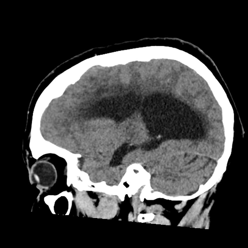 Chiasmatic-hypothalamic juvenile pilocytic astrocytoma (Radiopaedia 78533-91237 B 22).jpg