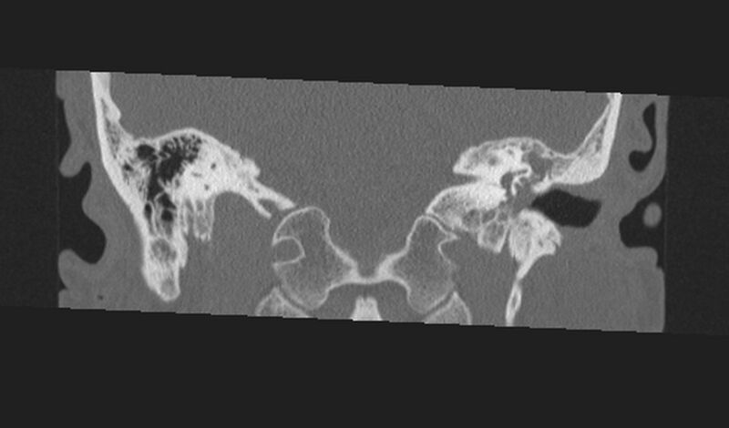 File:Cholesteatoma (Radiopaedia 10742-11203 Coronal bone window 16).jpg