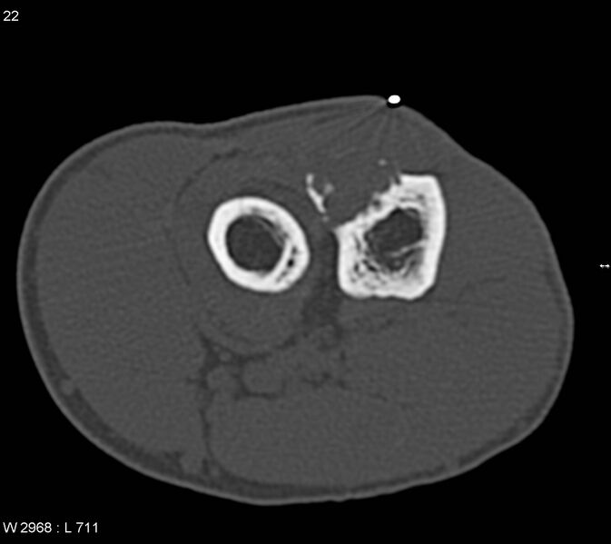 File:Chondromyxoid fibroma (Radiopaedia 6172-7625 Axial bone window 1).jpg