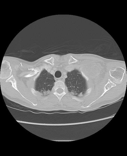 File:Chondrosarcoma (Radiopaedia 79427-92532 Axial lung window 8).jpg