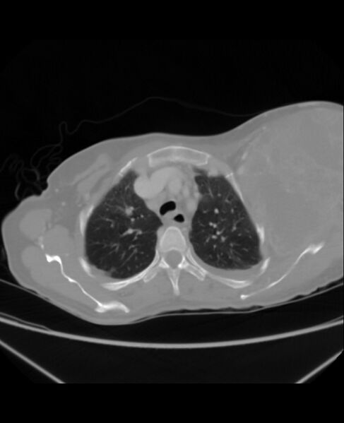 File:Chondrosarcoma (Radiopaedia 79427-92535 Axial lung window 12).jpg