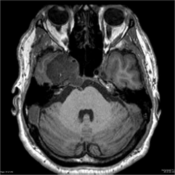 File:Chondrosarcoma of skull base- grade II (Radiopaedia 40948-43654 Axial T1 34).jpg