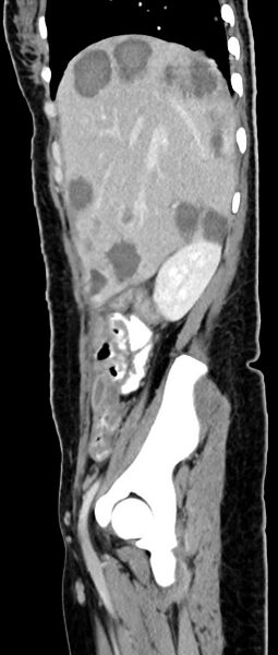File:Choriocarcinoma liver metastases (Radiopaedia 74768-85766 C 131).jpg