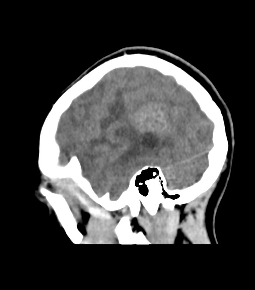 Choroid plexus carcinoma (Radiopaedia 91013-108552 B 60).jpg