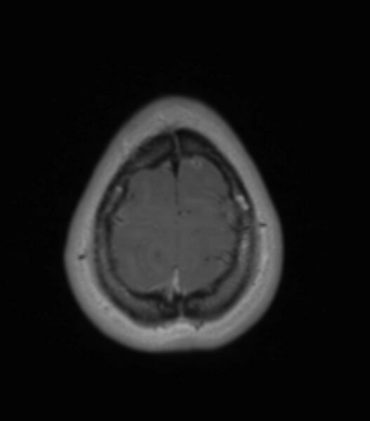 File:Choroid plexus carcinoma (Radiopaedia 91013-108553 Axial T1 C+ 195).jpg