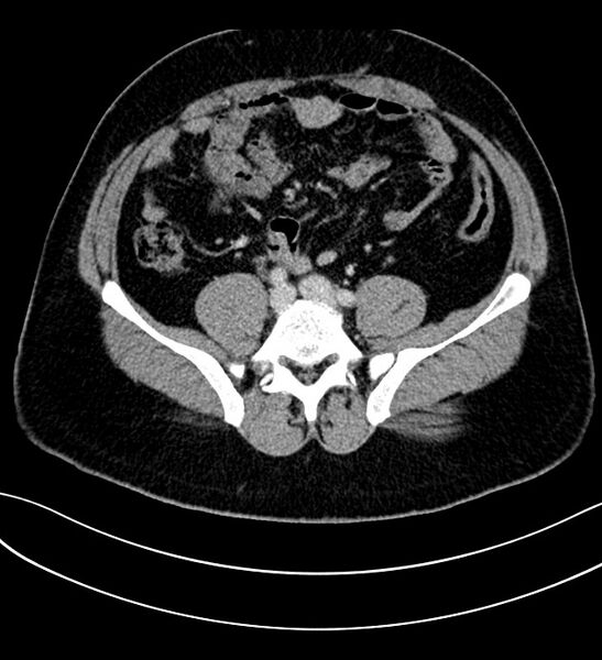 File:Chromophobe renal cell carcinoma (Radiopaedia 84286-99573 G 48).jpg