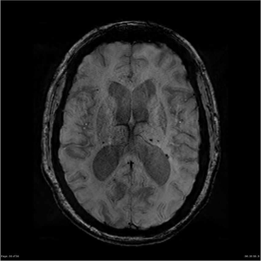 Chronic hypertensive encephalopathy (Radiopaedia 25764-25918 Axial SWI 30).jpg