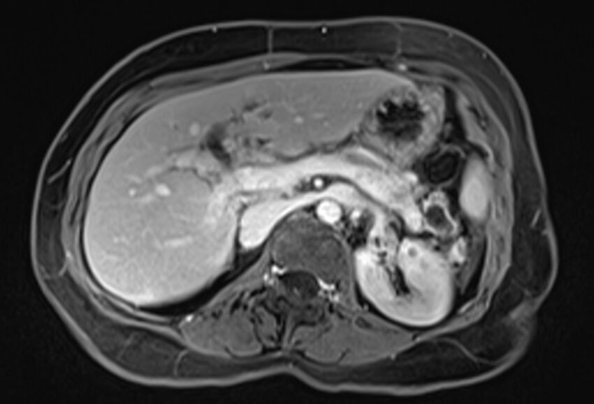 Chronic pancreatitis - pancreatic duct calculi (Radiopaedia 71818-82250 Axial T1 C+ fat sat 24).jpg