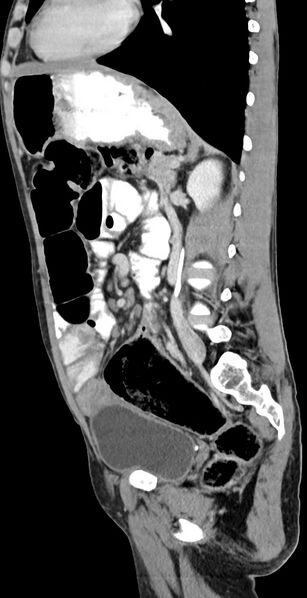 File:Chronic small bowel volvulus (Radiopaedia 75224-86322 C 60).jpg