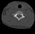 Clay-shoveler fracture (Radiopaedia 22568-22590 Axial bone window 60).jpg