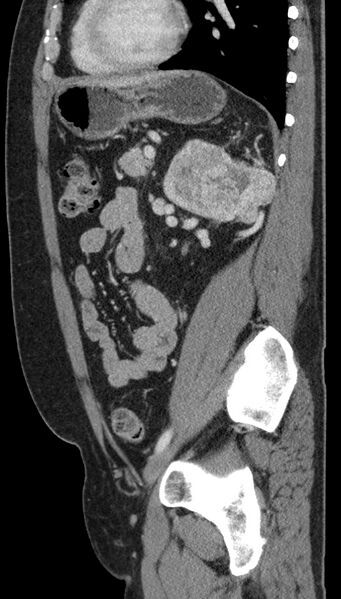 File:Clear cell renal cell carcinoma (Radiopaedia 61449-69393 G 33).jpg