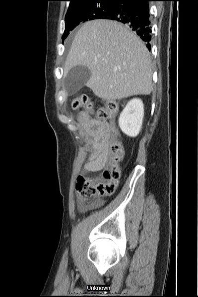 File:Closed loop bowel obstruction and ischemia (Radiopaedia 86959-103180 C 55).jpg