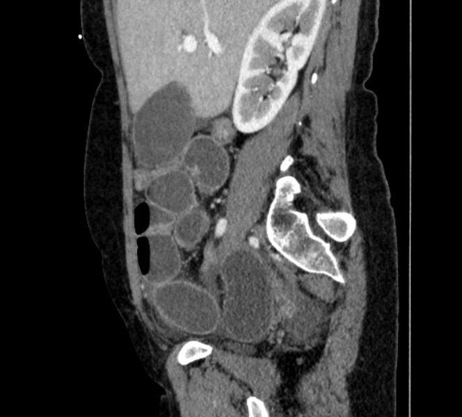 File:Closed loop small bowel obstruction (Radiopaedia 71211-81508 C 40).jpg