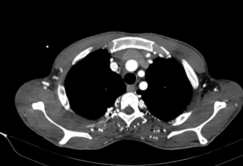 File:Coarctation of aorta with aortic valve stenosis (Radiopaedia 70463-80574 A 14).jpg